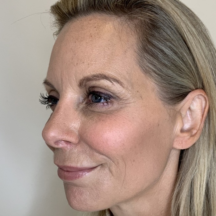 Efter: rynkebehandling hos CeriX