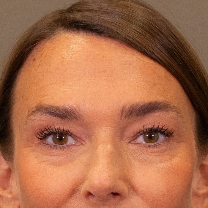 Efter: rynkebehandling hos CeriX
