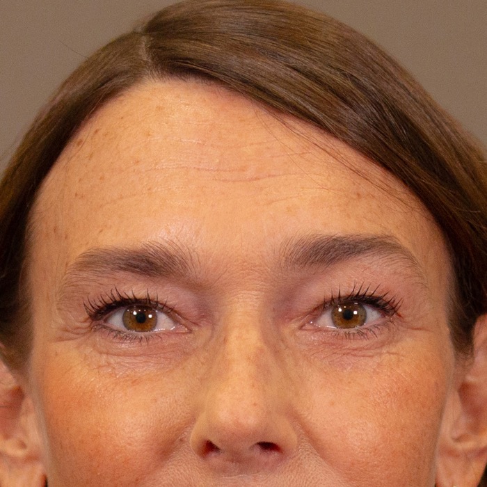 Før: rynkebehandling hos CeriX