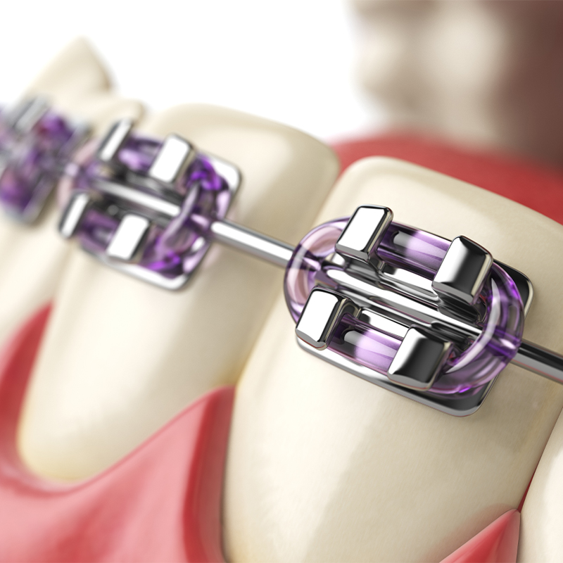 Types of Braces at Nance Orthodontics