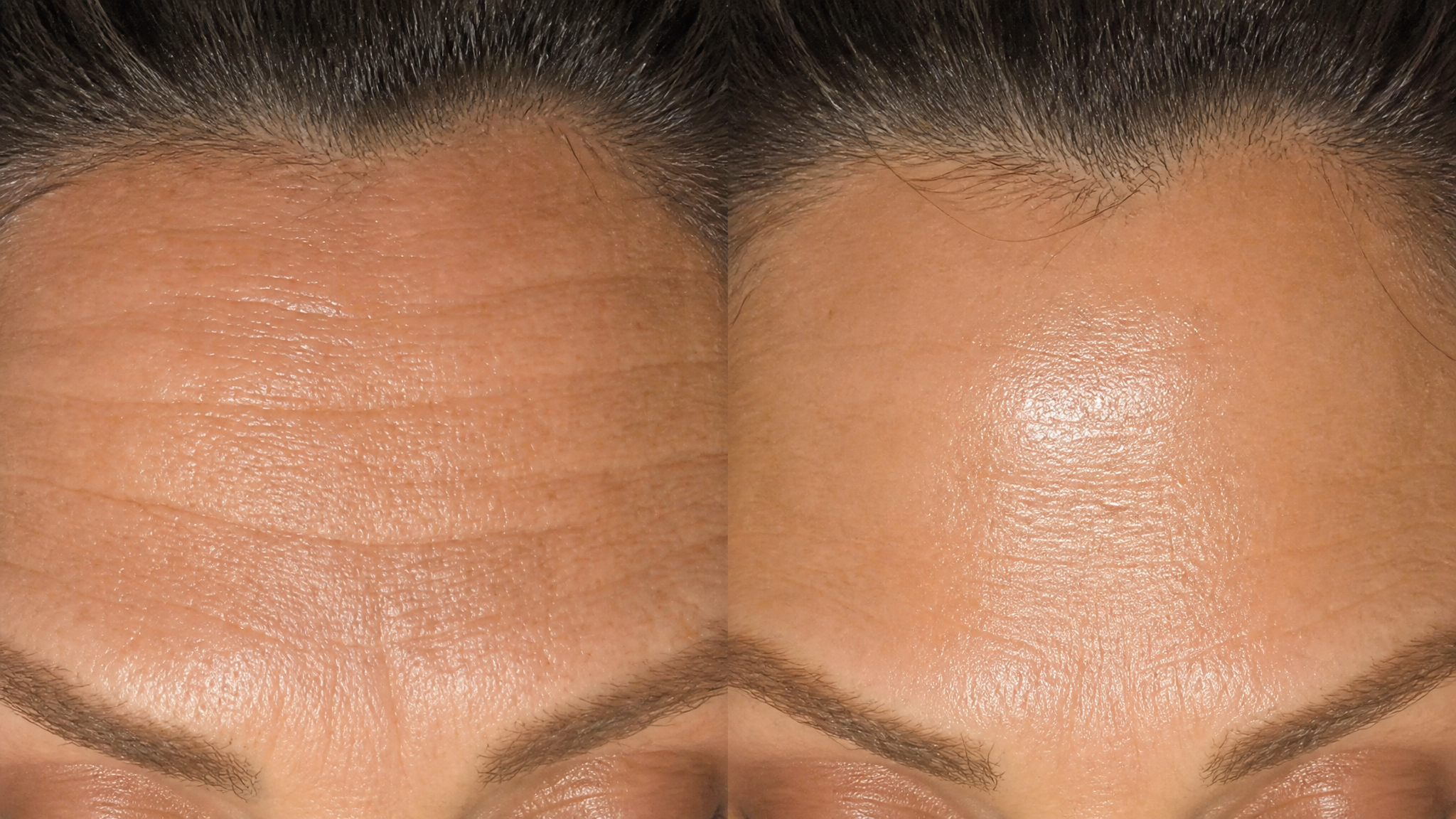 Huid voor en na een HydraFacial behandeling bij SieroSanto in Ieper
