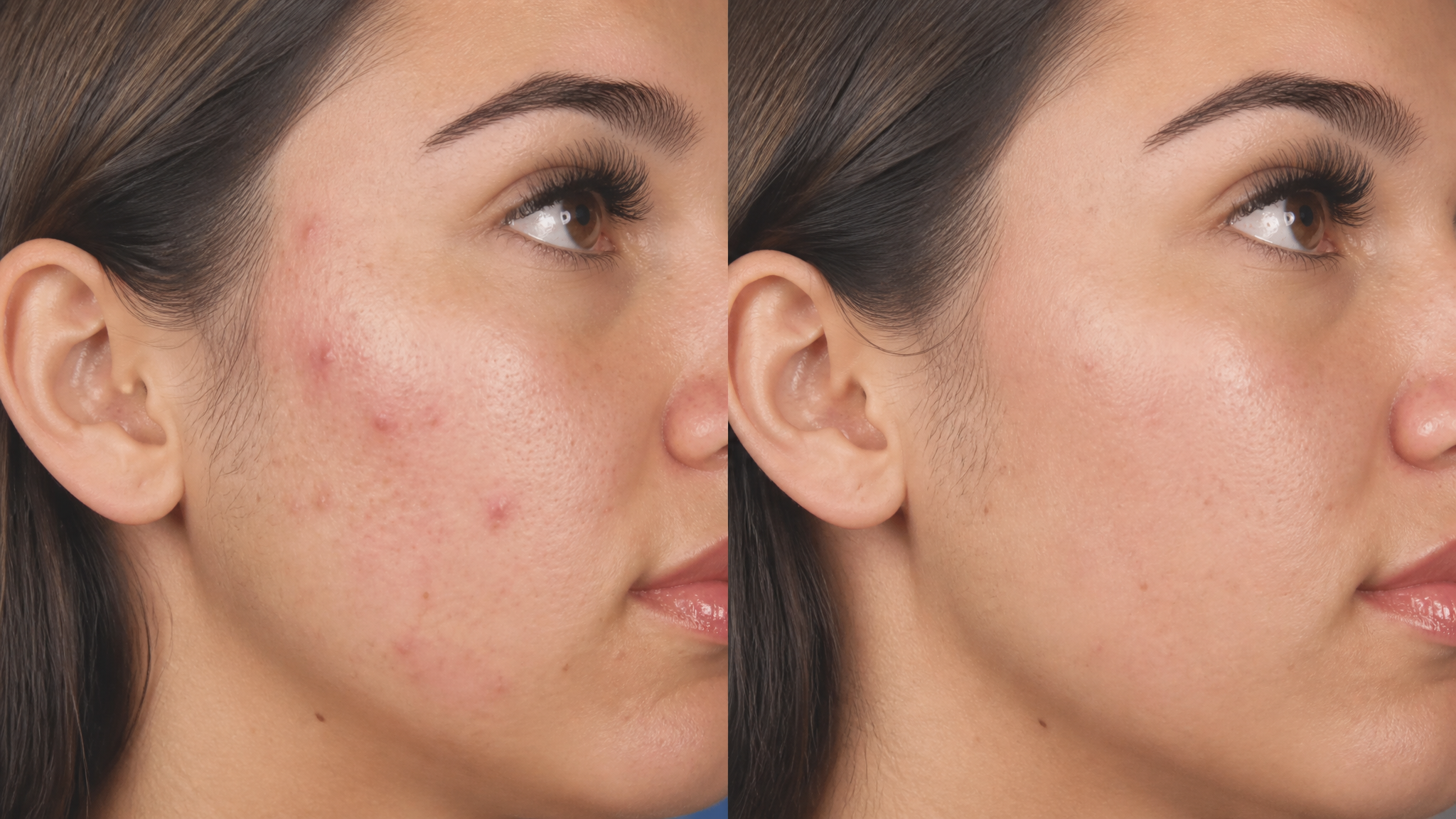 Huid voor en na een HydraFacial behandeling bij SieroSanto in Ieper