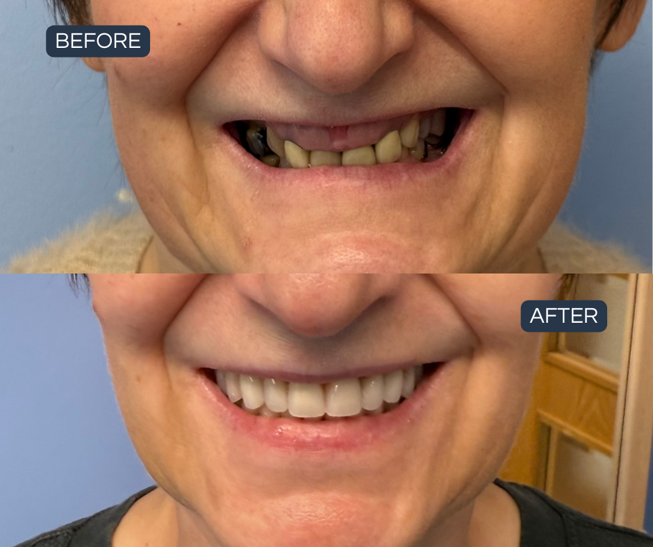 Missing teeth restored with a fixed, natural smile — Smile Success