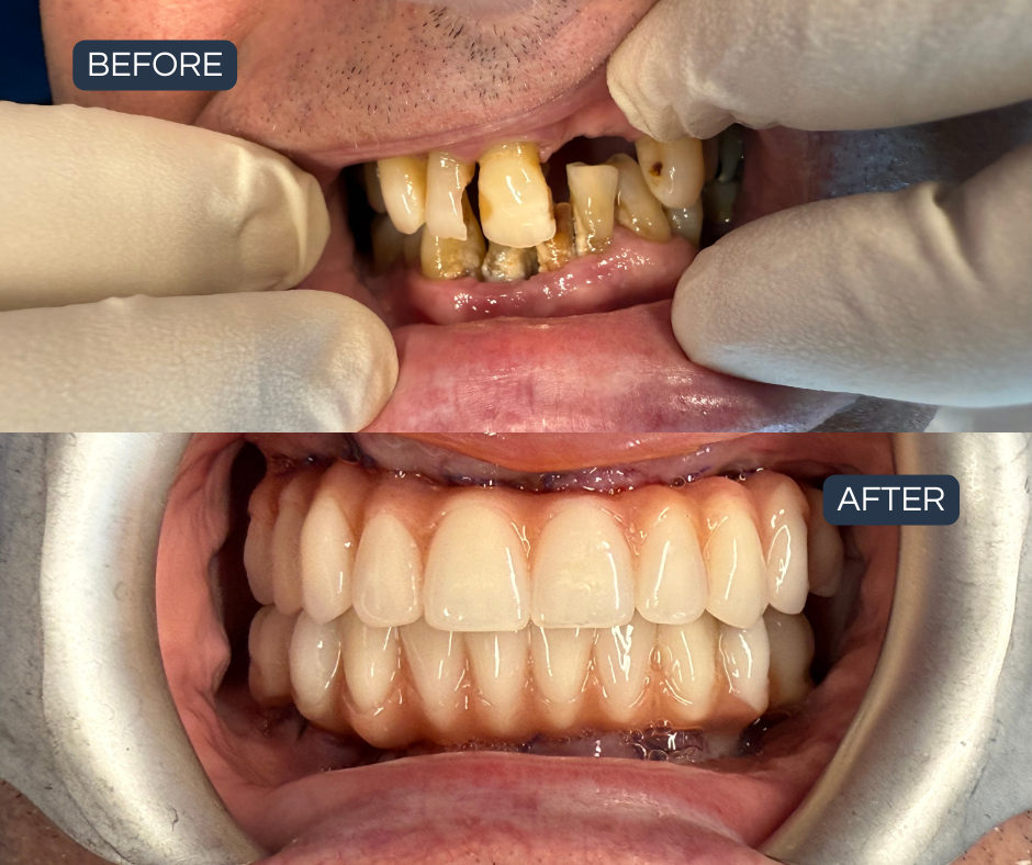 Failing teeth replaced with fixed full-arch implants — Smile Success