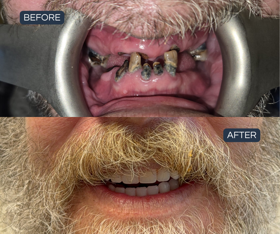 A rebuilt bite and a confident new smile — Smile Success
