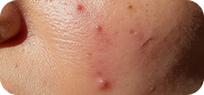 Acne