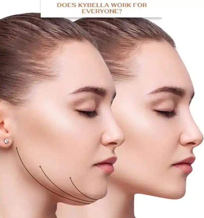 Kybella injection for double chin fat reduction in Saint Clair Shores