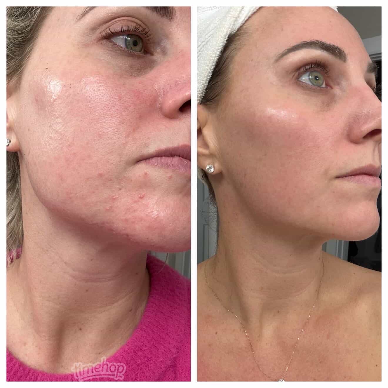Client skin before and after