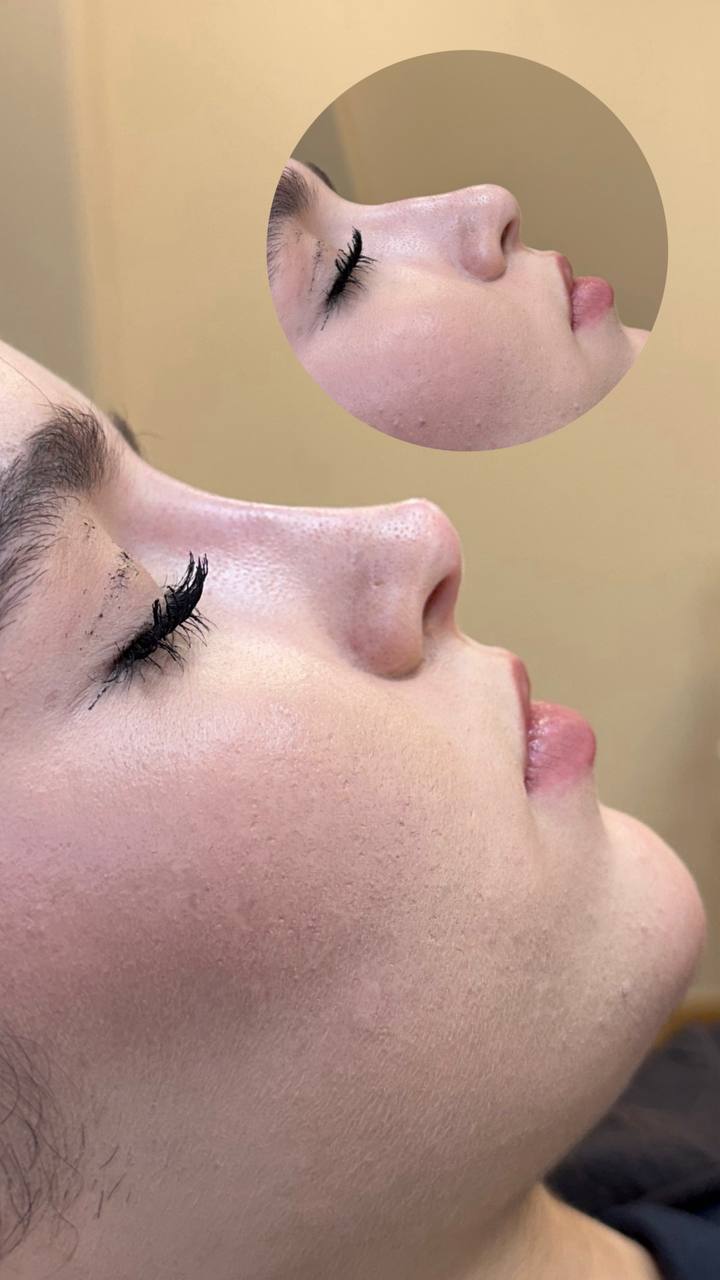 Resultado inmediato de rinomodelación, con el perfil anterior en el círculo