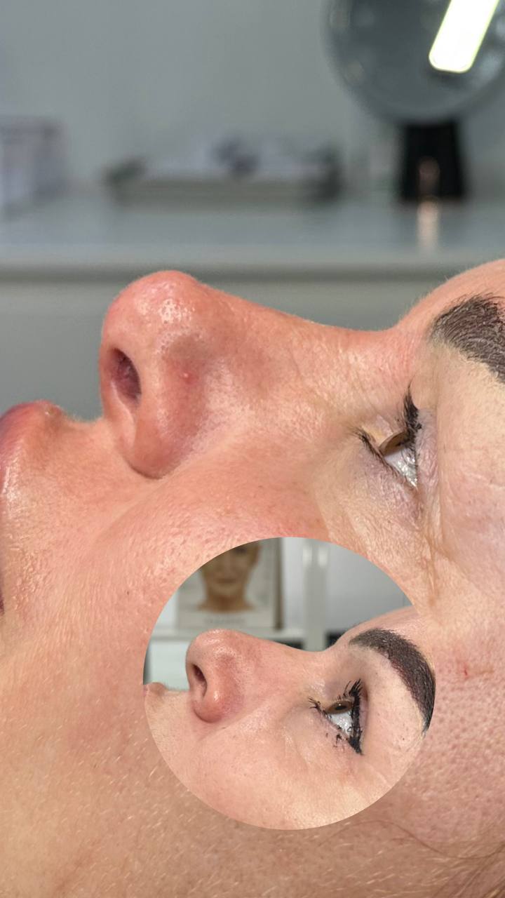 Resultado inmediato de rinomodelación, con el perfil anterior en el círculo