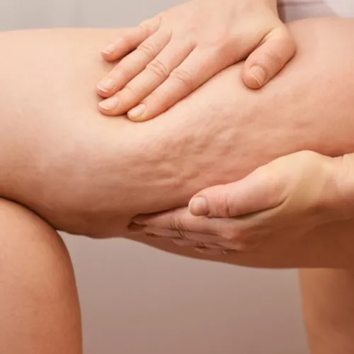 Celulitis