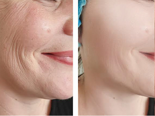 Wrinkle Removal in 7611 W Thomas Rd, Phoenix, AZ 85033