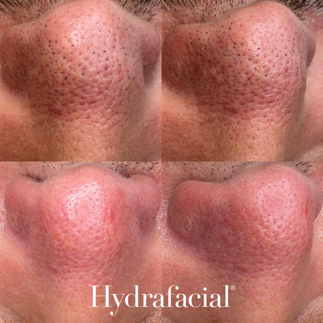 HydraGlow Before and After - Hydration and Radiance