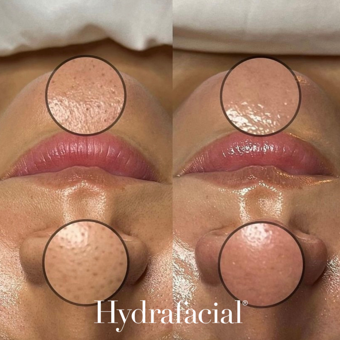 HydraGlow Before and After - Pore Refinement