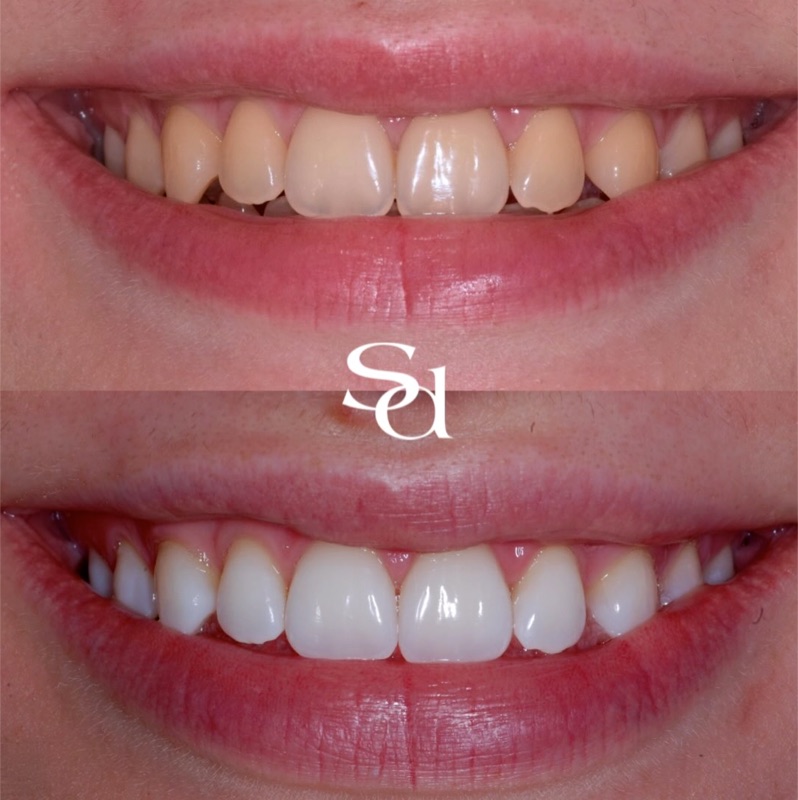 Before and after smile makeover - Sale Dental Spa