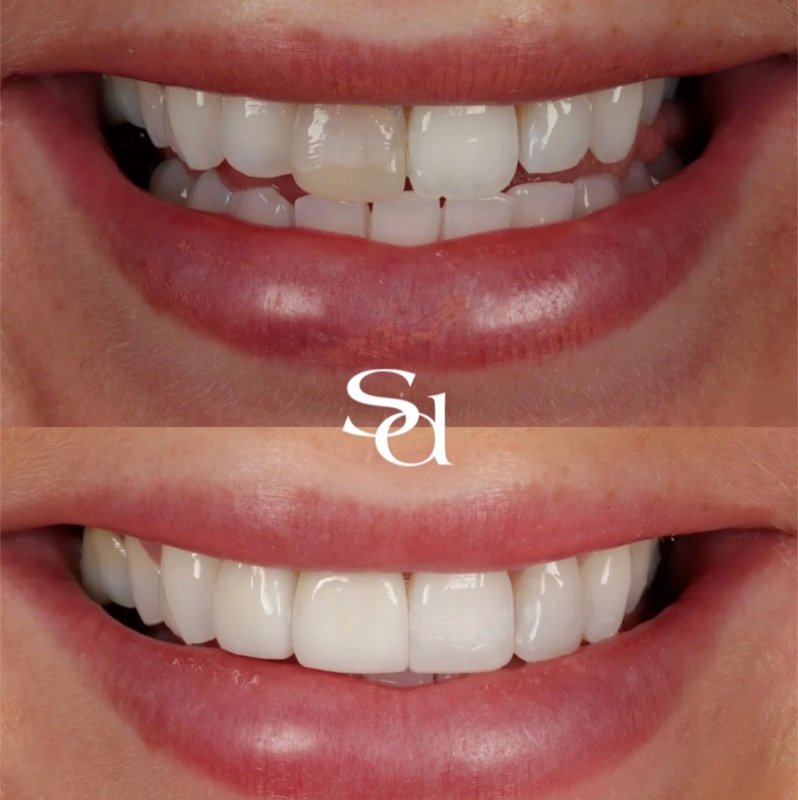 Before and after smile transformation - Sale Dental Spa