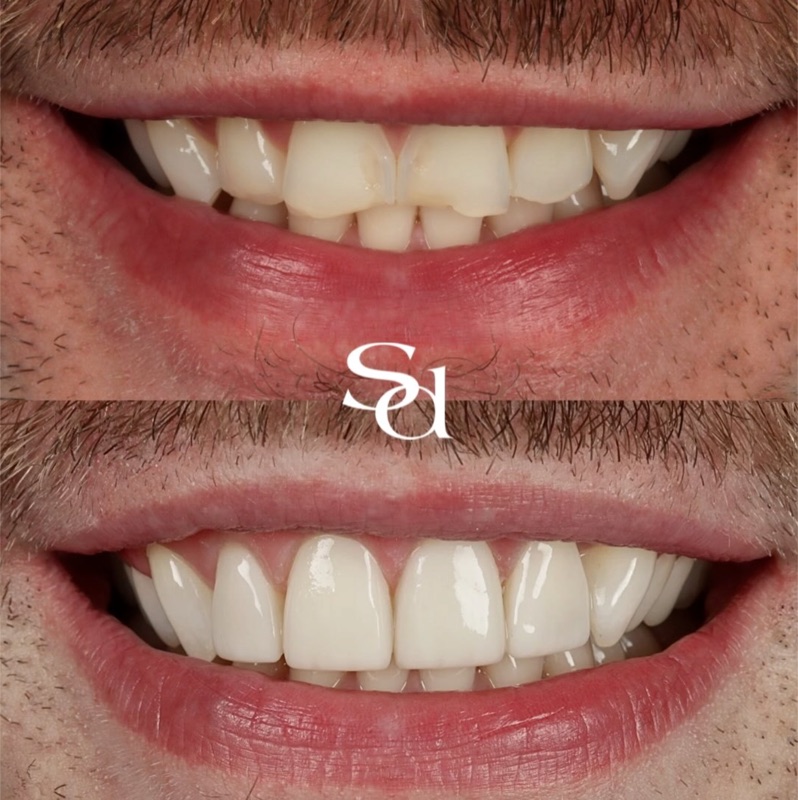 Before and after real patient result - Sale Dental Spa