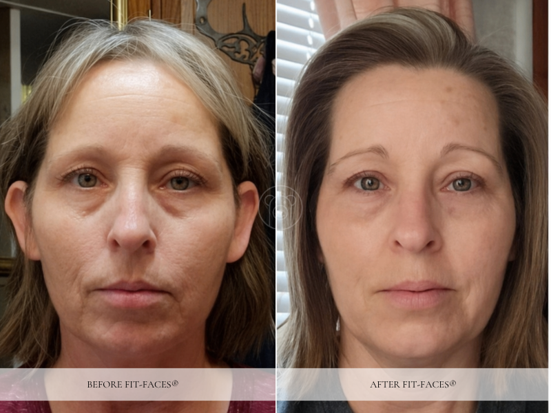 Before and after: double chin gone, relaxed chin