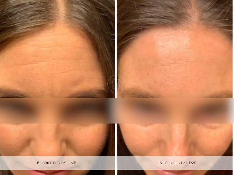 Before and after: defined cheekbones, sharp jawline
