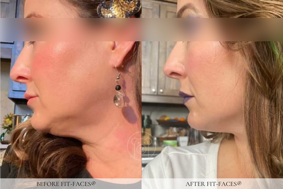 Before and after: uplifted cheeks, sharp jawline