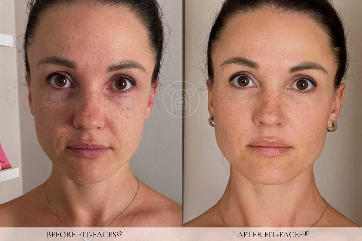 Before and after: smoother forehead, laugh lines gone