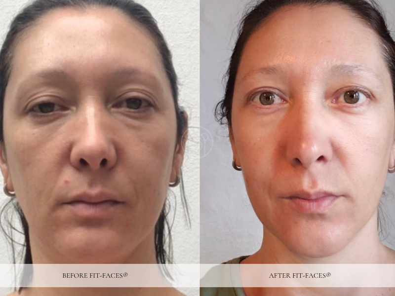Before and after: jowls reduced, jawline defined