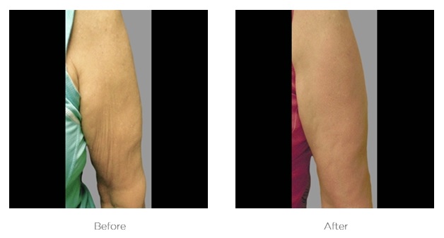 Before and after BTL Exilis Ultra Body upper arm contouring and tightening at Knightsbridge Advanced Beauty London