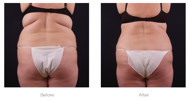 Exilis fat reduction and skin tightening result on thighs at London clinic
