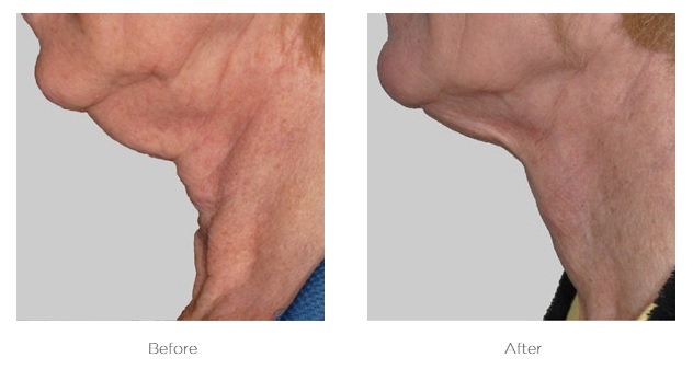 Real Exilis Face client result showing smoother neck and tighter skin