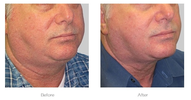 Real Exilis Face client result showing lifted jawline and reduced sagging