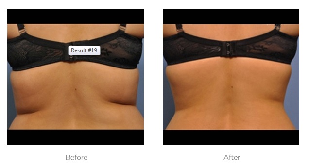 Exilis Ultra 360 body contouring treatment on stomach in Knightsbridge London