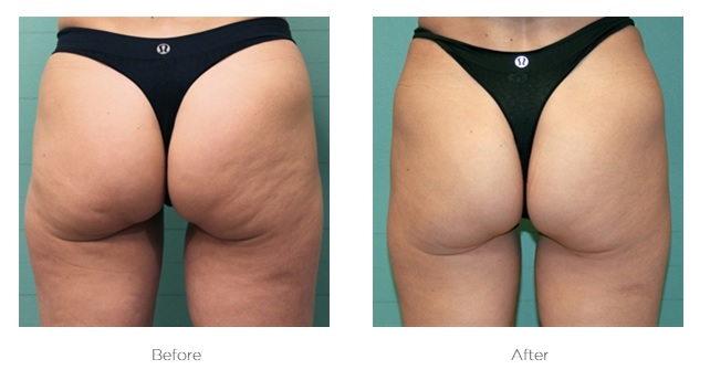 Exilis non-surgical skin tightening treatment session near Chelsea