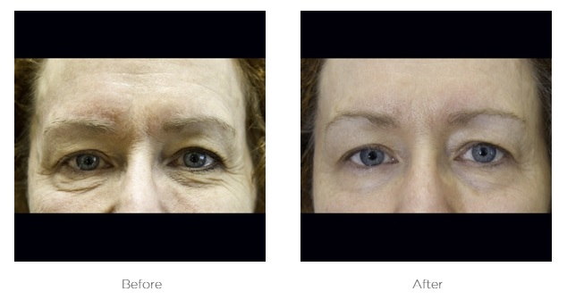 Real Exilis Face client result showing firmer facial skin and improved contour