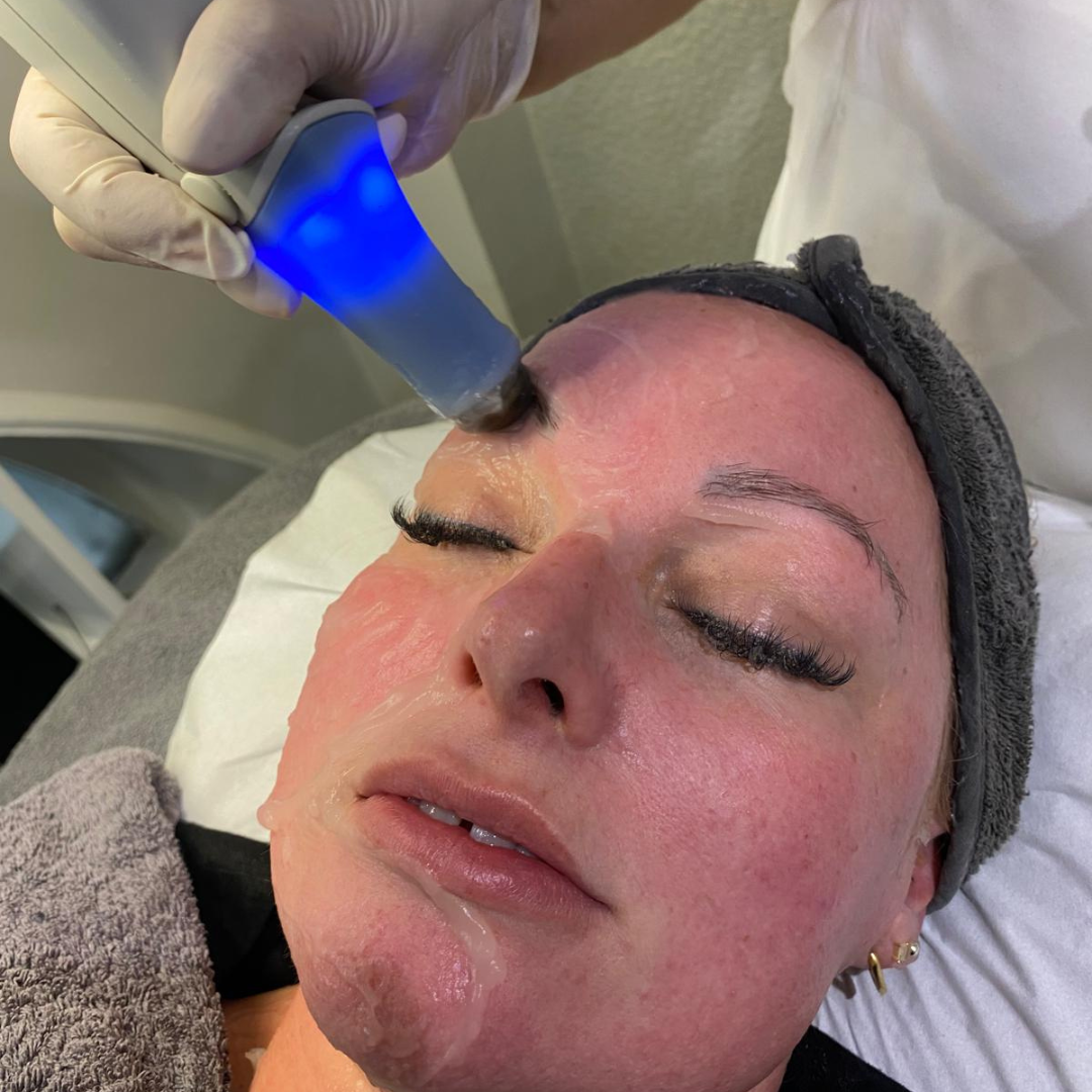 Before and after Exilis Face treatment showing firmer, smoother facial skin