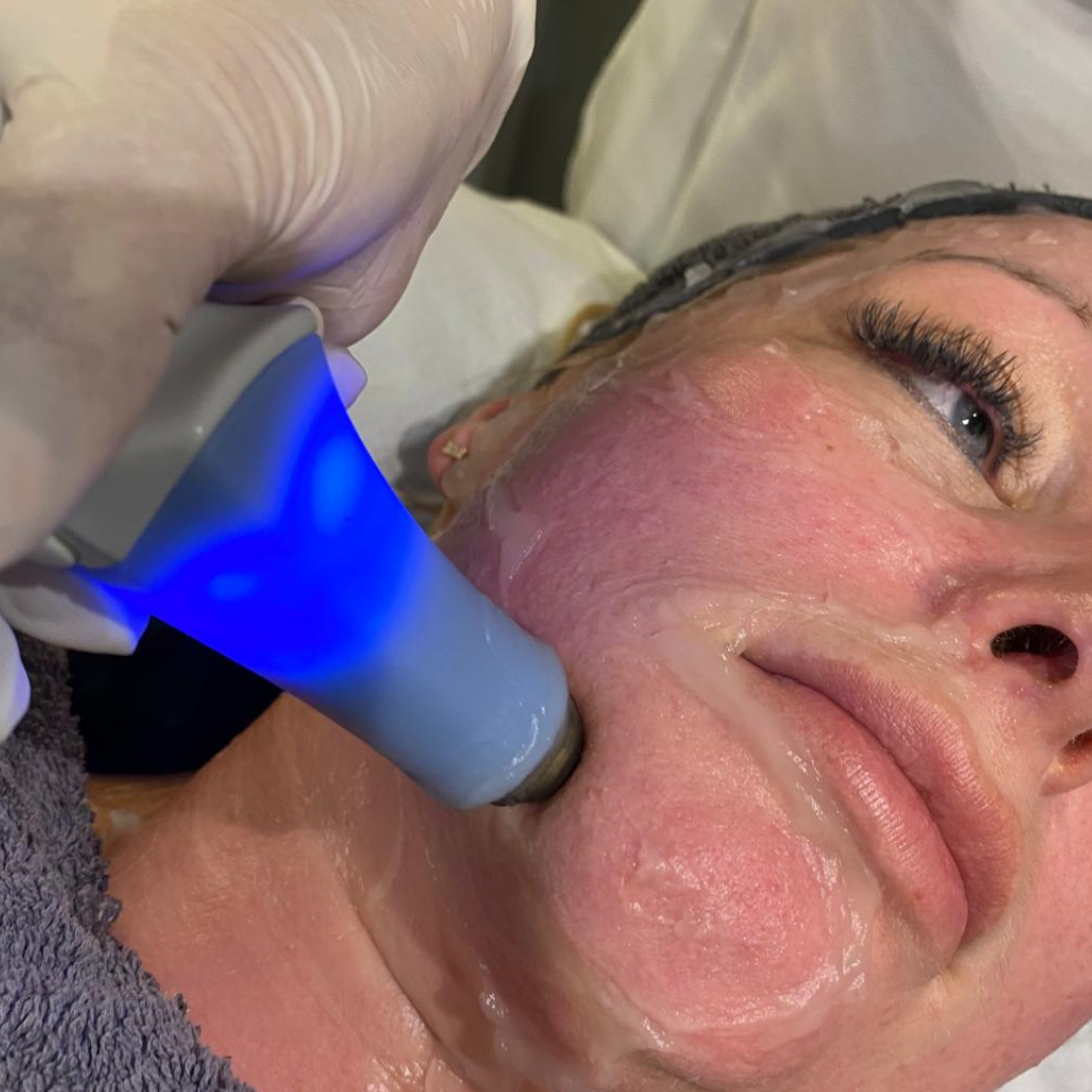 Exilis Face neck tightening results showing improved contour and firmness