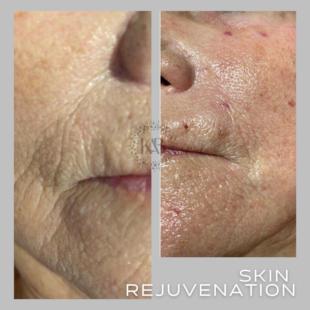 Karisma Injection Treatment