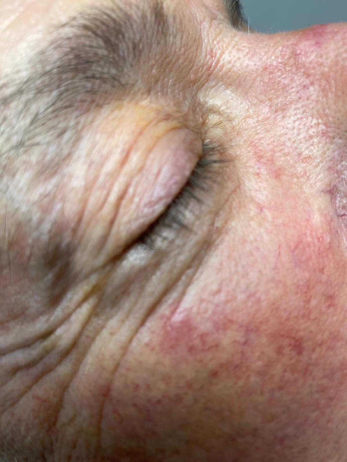 Before treatment