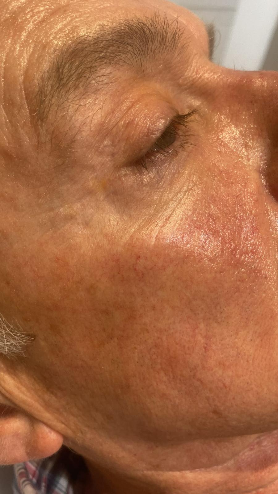 After treatment