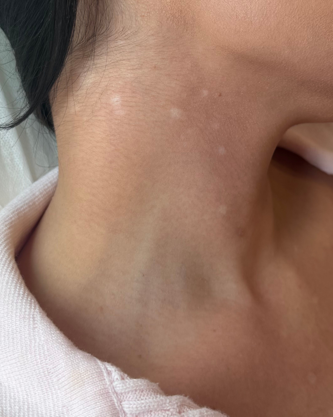 photo of white acne scars on clients neck 