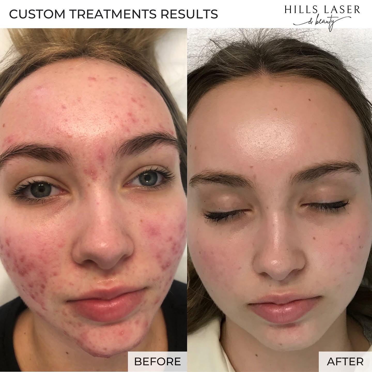 Overall Radiance & Clarity — client result at Hills Laser & Beauty