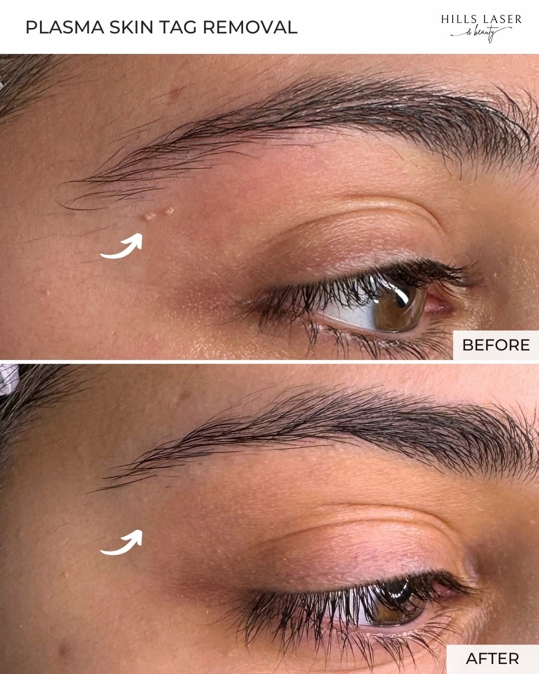Hydration & Glow Restoration — client result at Hills Laser & Beauty
