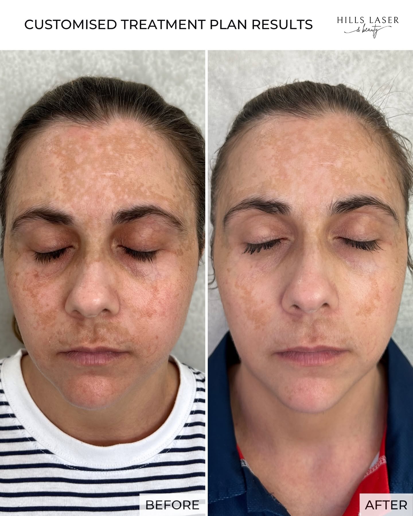 Redness & Vascular Clarity — client result at Hills Laser & Beauty