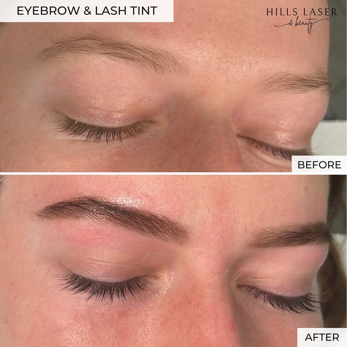 Acne Scarring & Congestion — client result at Hills Laser & Beauty