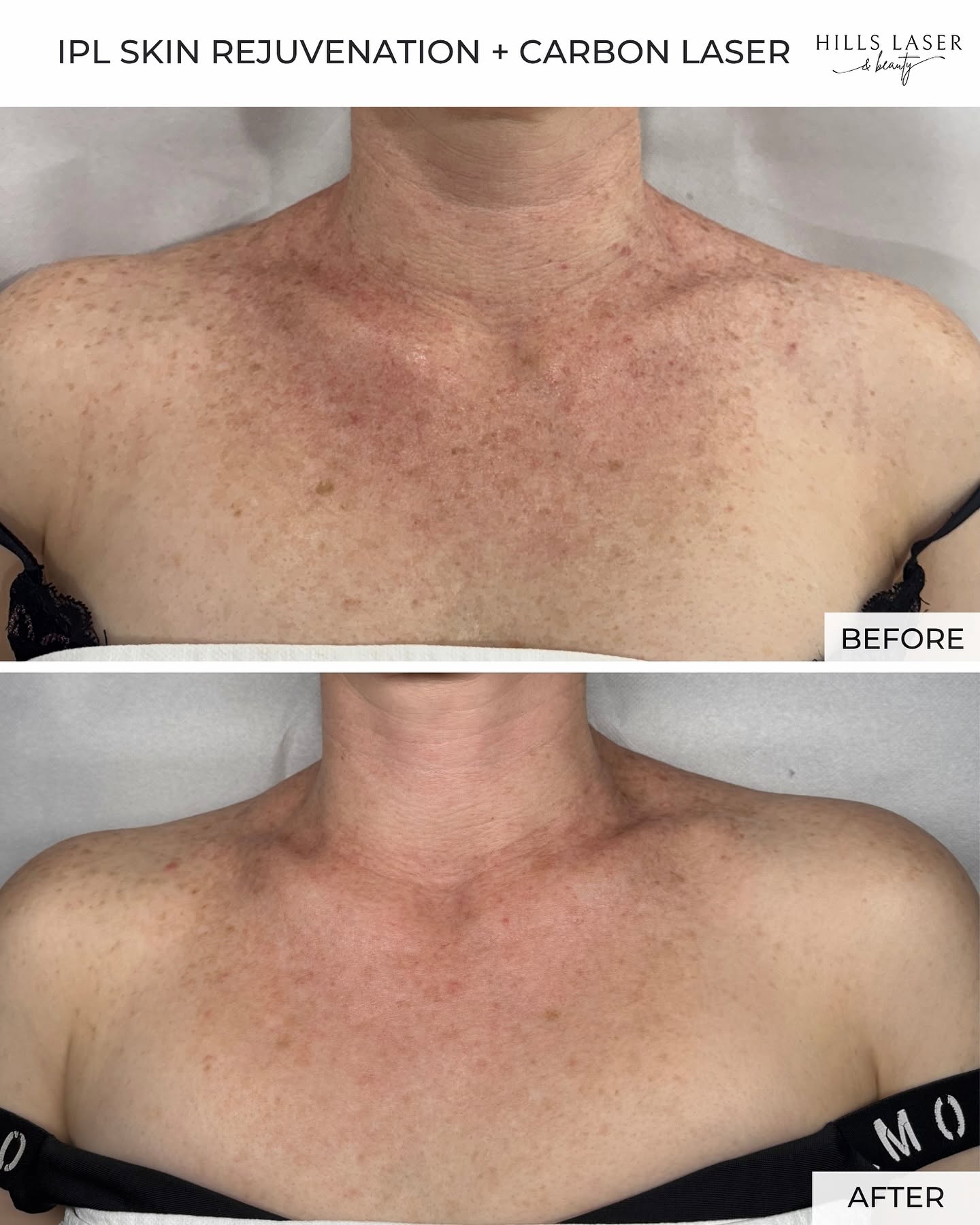 Fine Lines & Firmness — client result at Hills Laser & Beauty