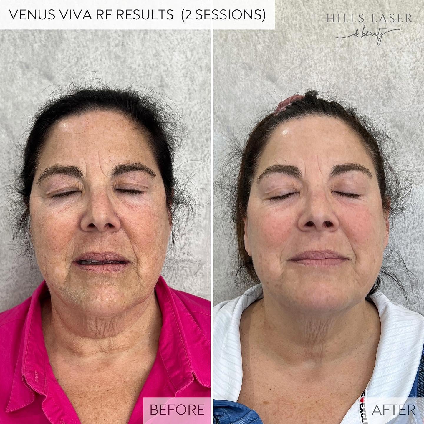 Skin Tightening & Definition — client result at Hills Laser & Beauty