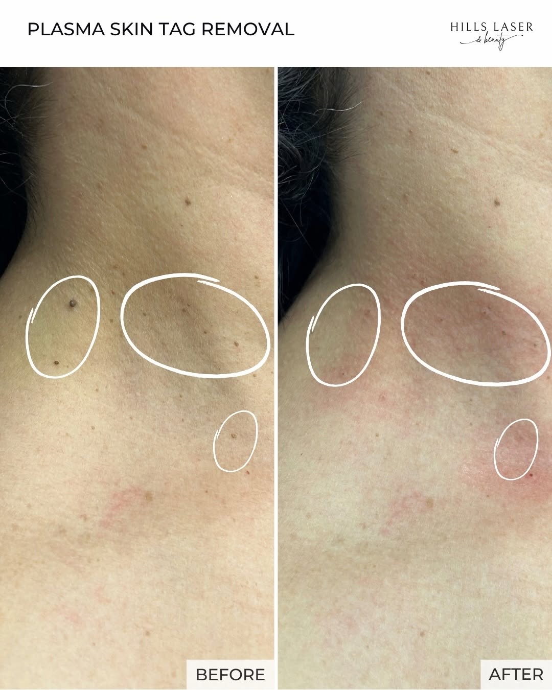 Pigmentation & Sun Damage — client result at Hills Laser & Beauty