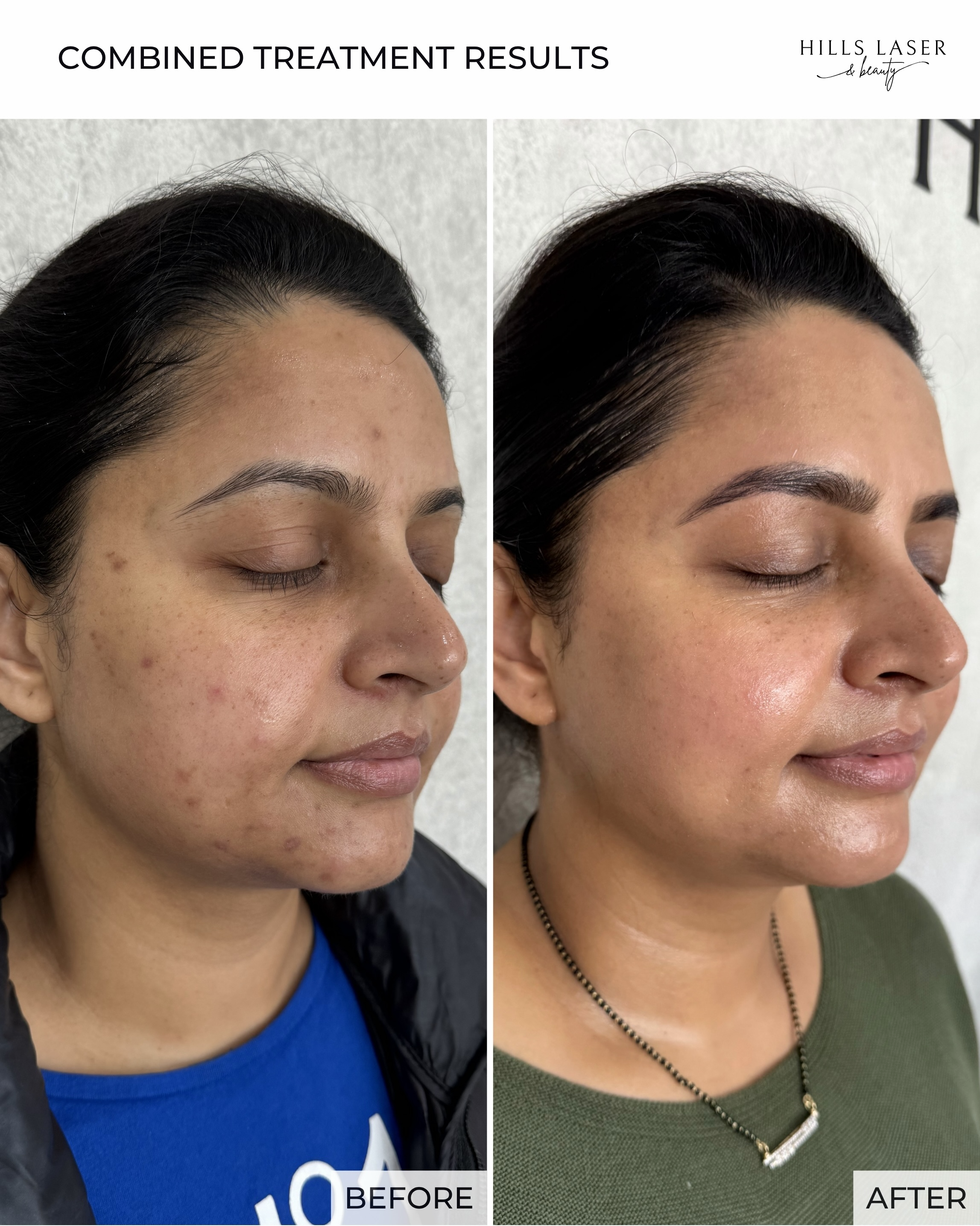 Texture & Tone Refinement — client result at Hills Laser & Beauty