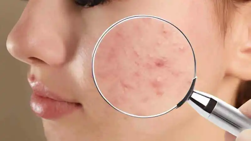 Tratamento de Acnes e Cicatrizes