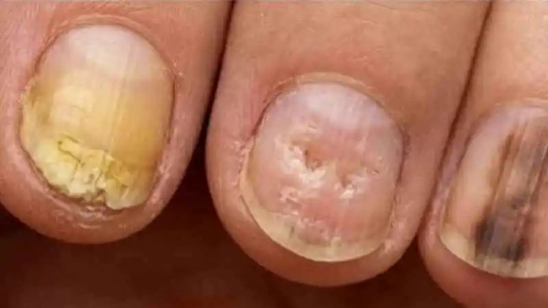 Onicologia (Doenças nas unhas)