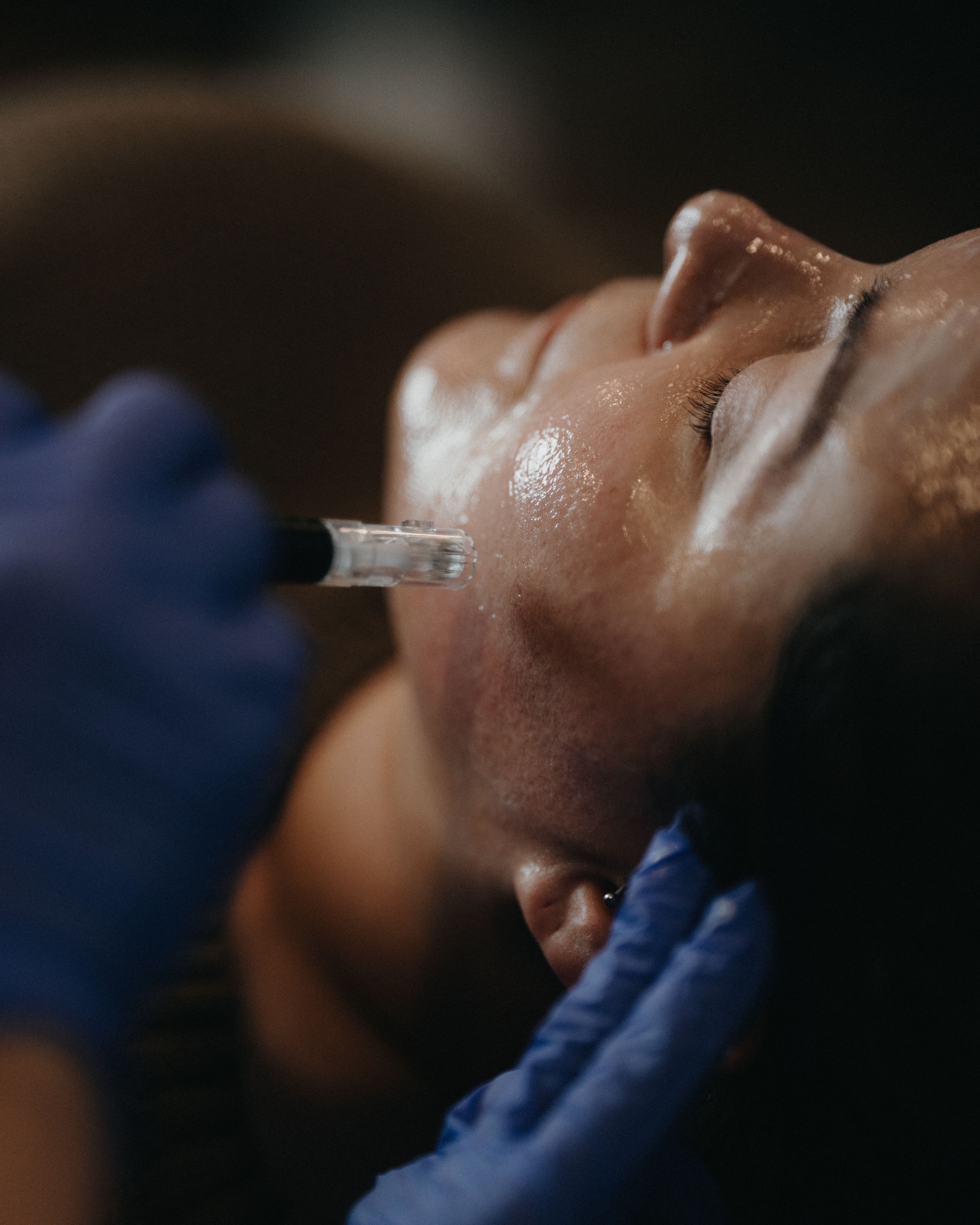 Microneedling at D'Vinely You Aesthetics